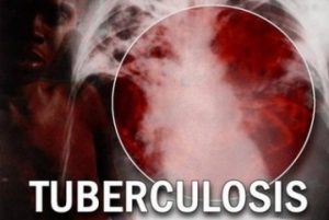 Ilustrasi penyakit Tuberculosis